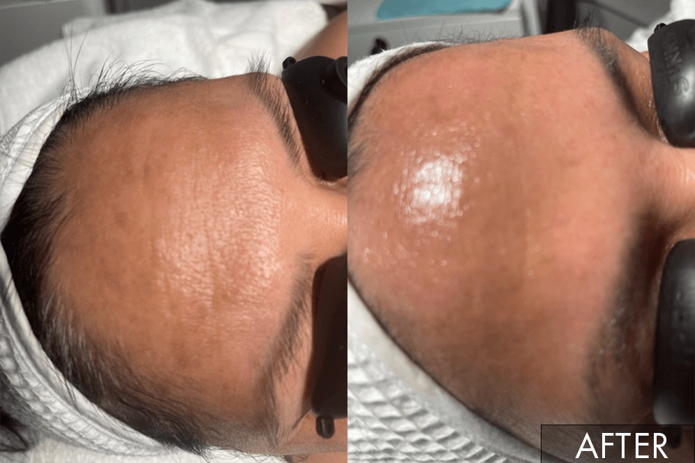 hydrafacial results