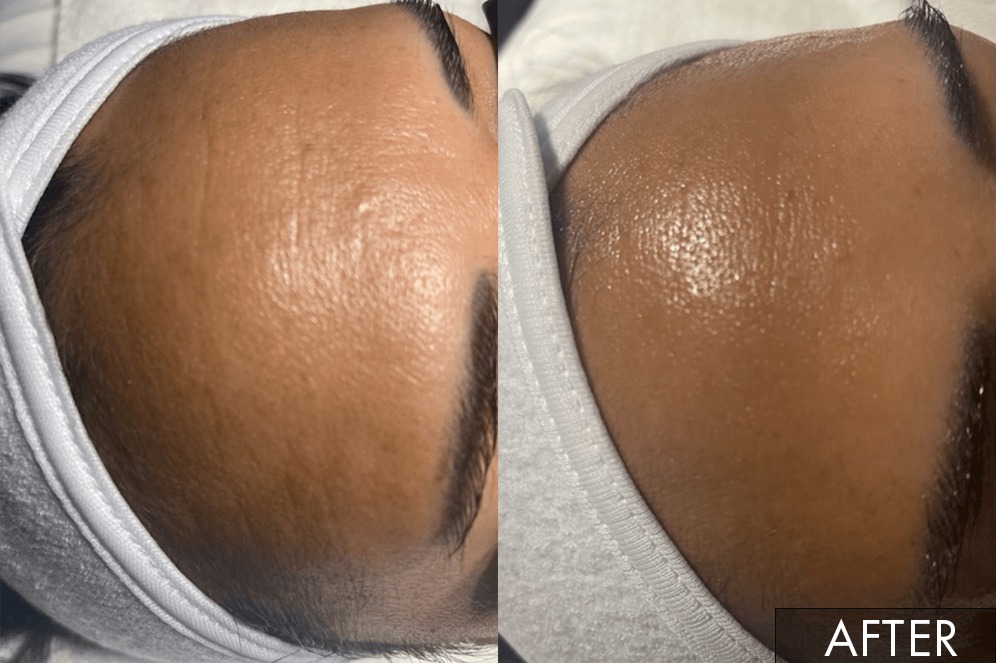 Forehead treatment comparison