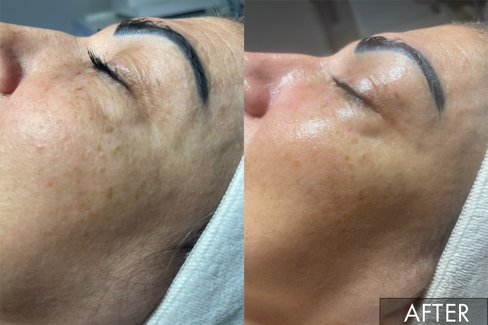 Collagen Therapy Results