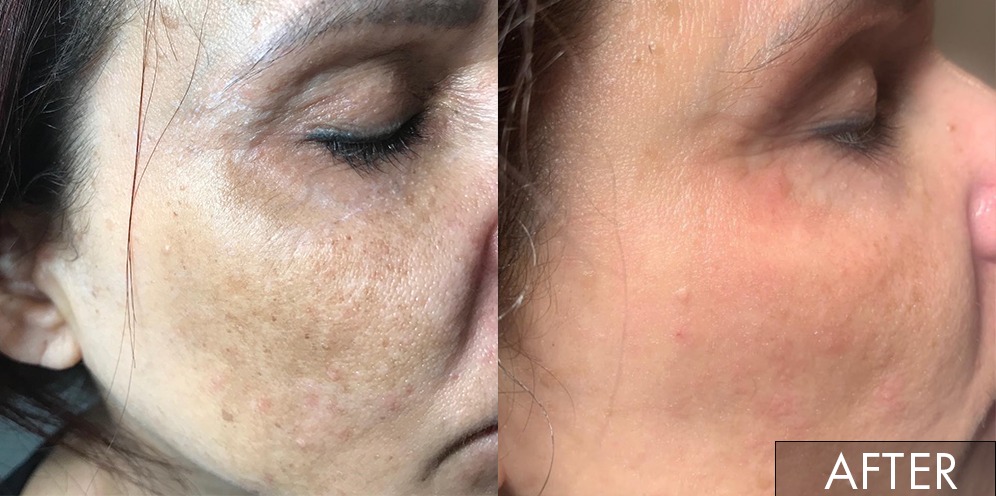 Dermplaning Before After