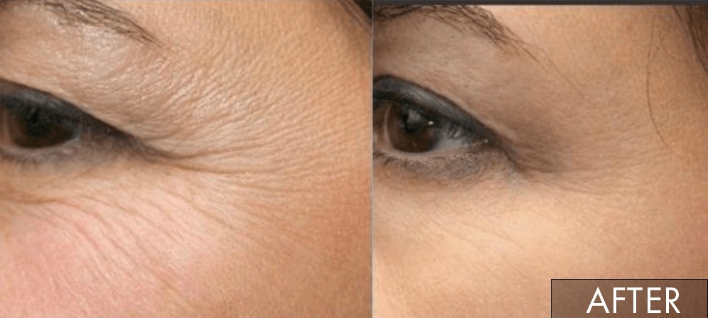 PDRN Rejuvenation Results