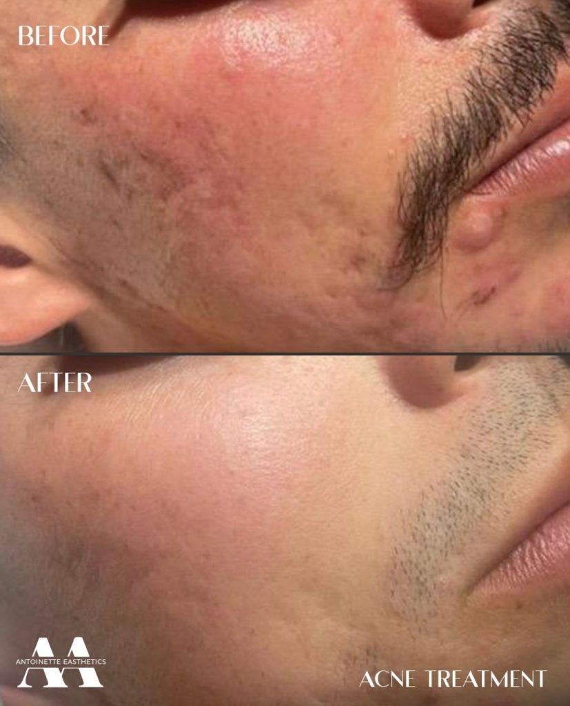 before and after acne scars