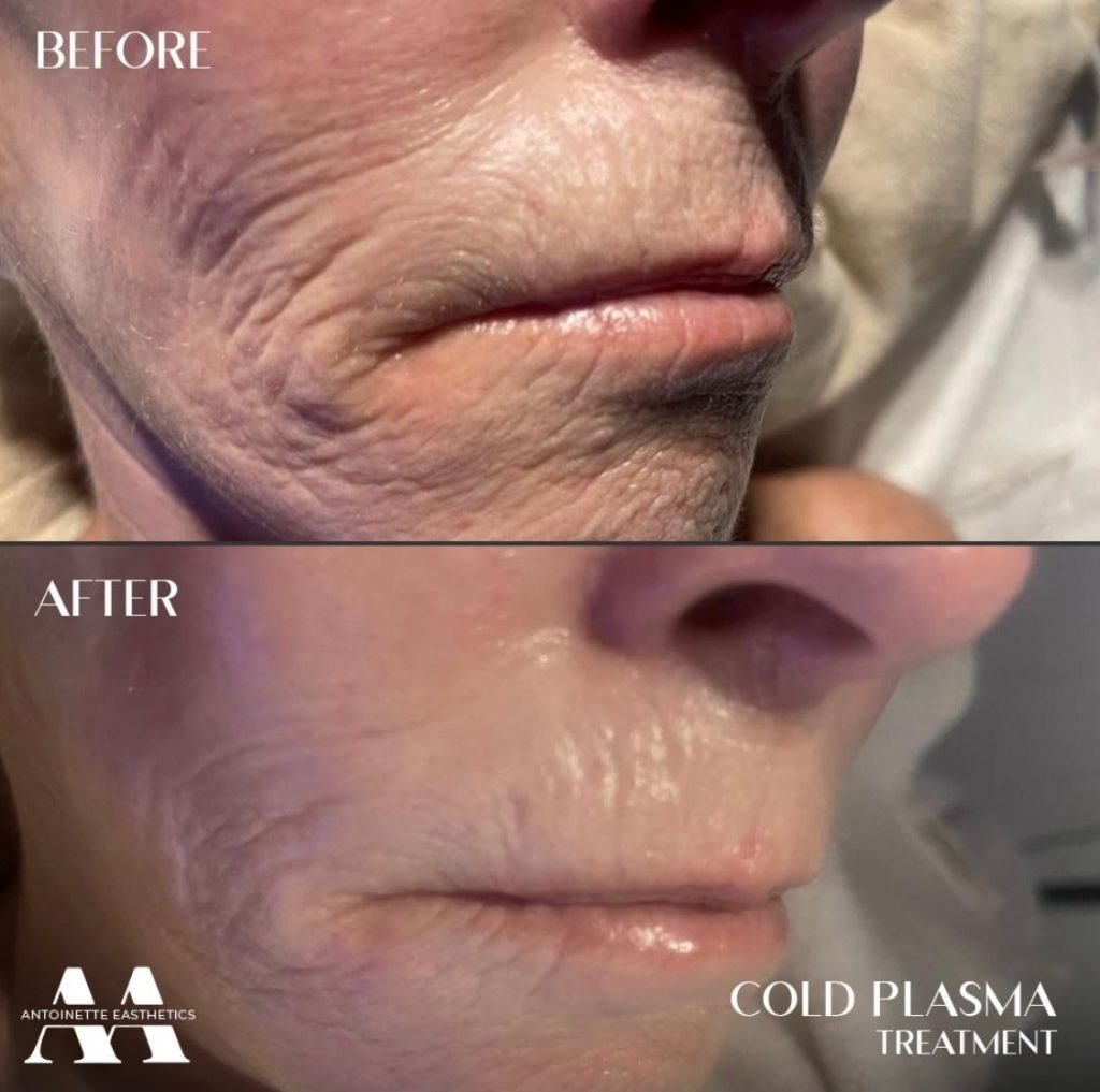 before and after cold plasma