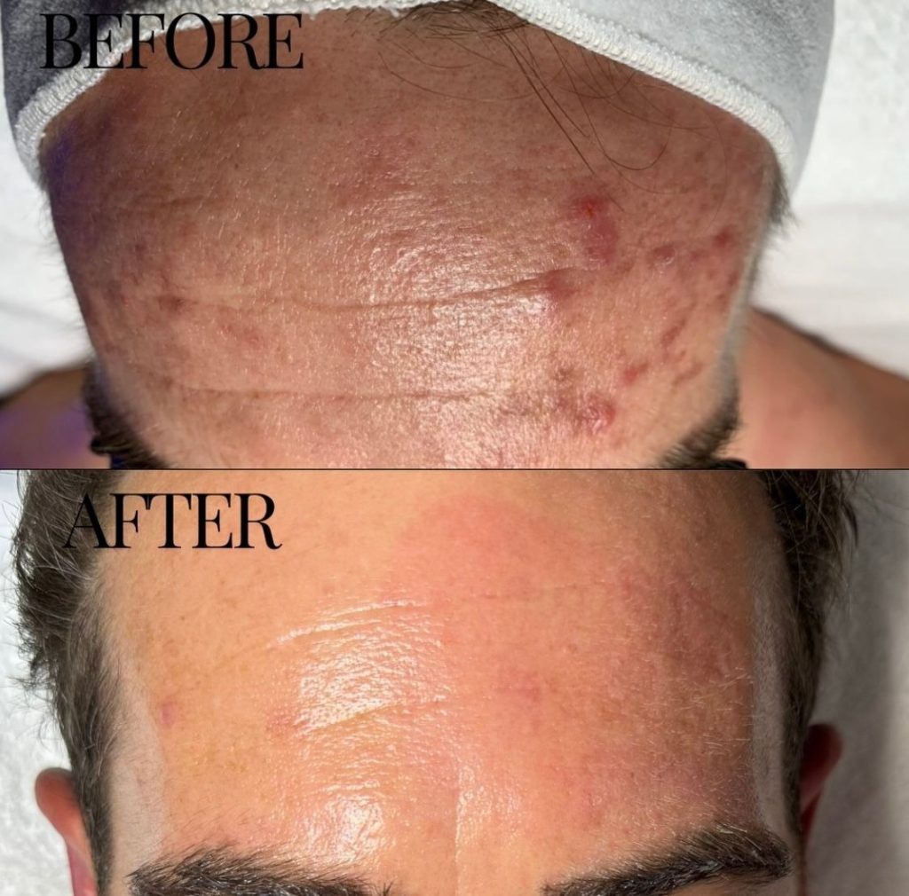 before and after hydrafacial forehead