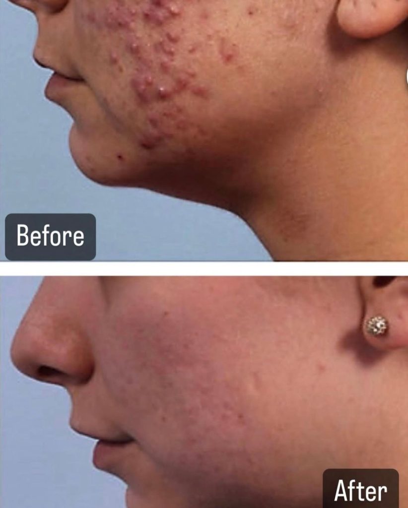 before and after hydrafacial