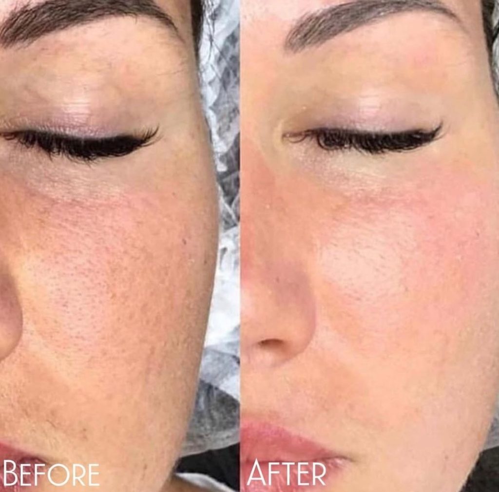 before and after dermaplaning