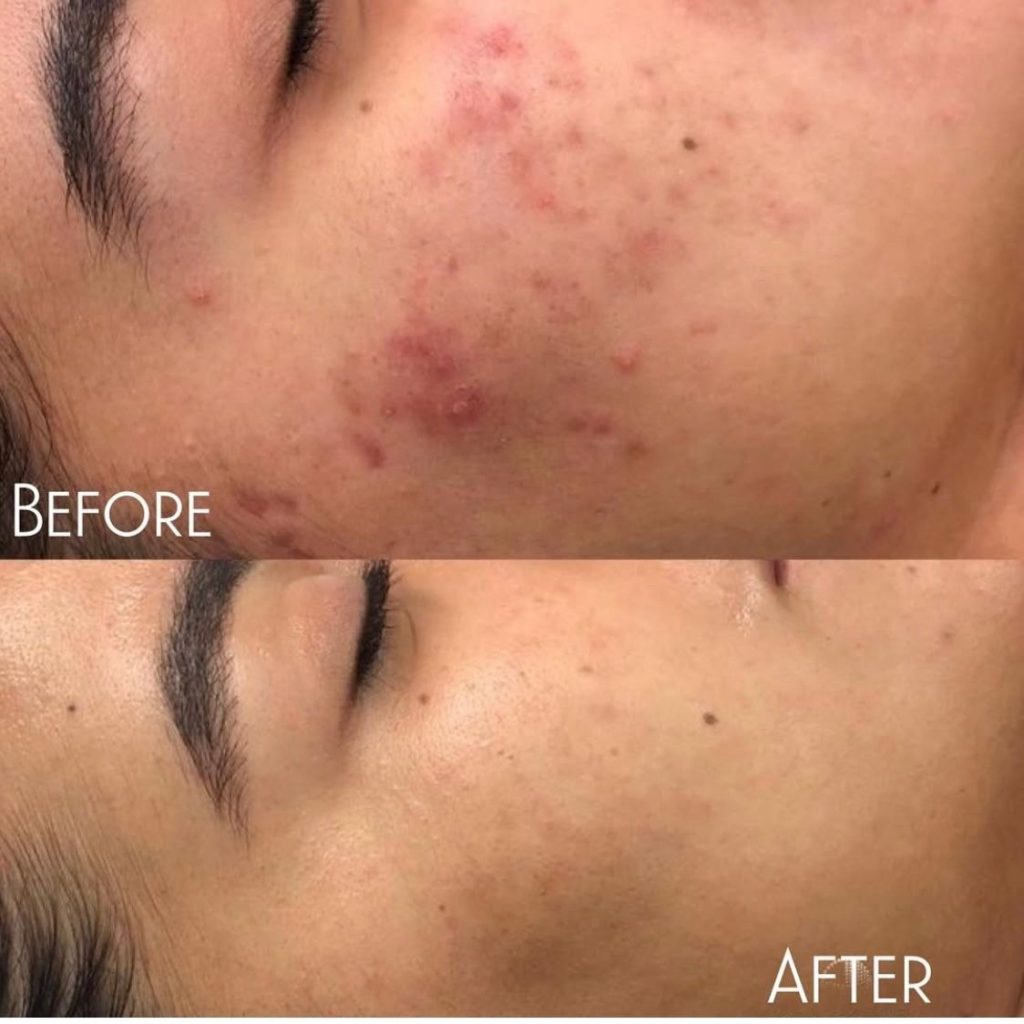 before and after acne treatment