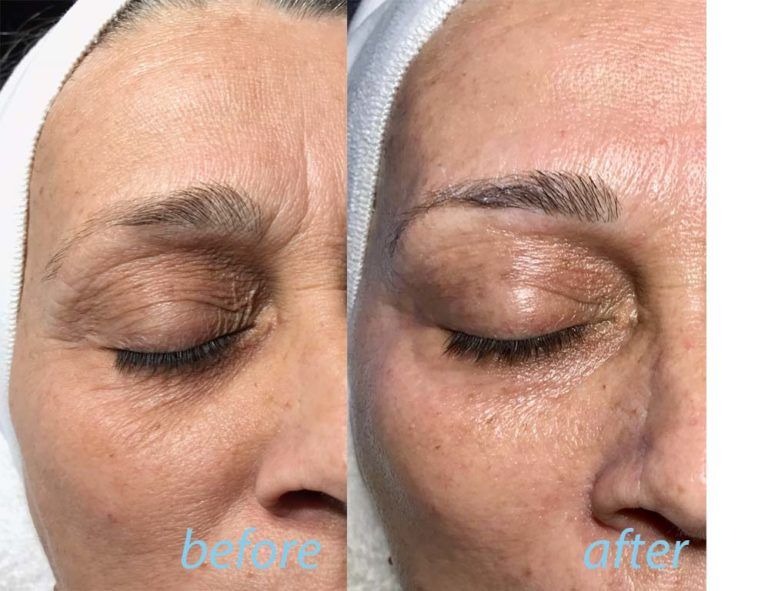 wrinkles and anti aging