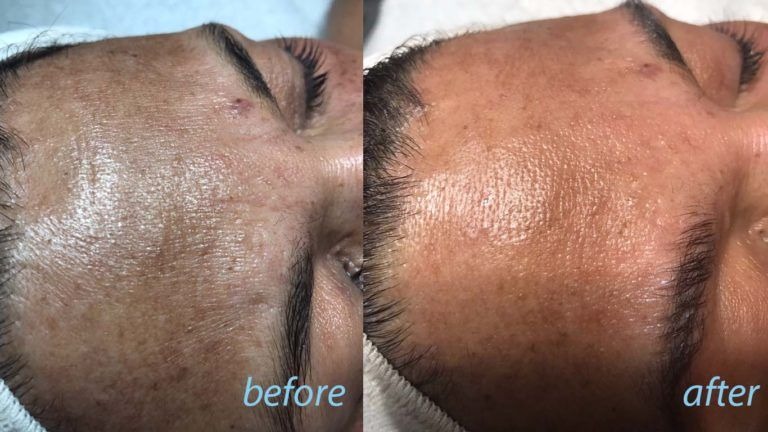 microneedling