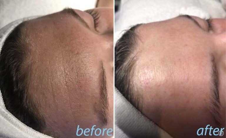 skin pigmentation after treatment