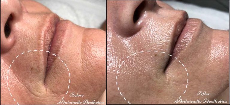 skin treatment Results