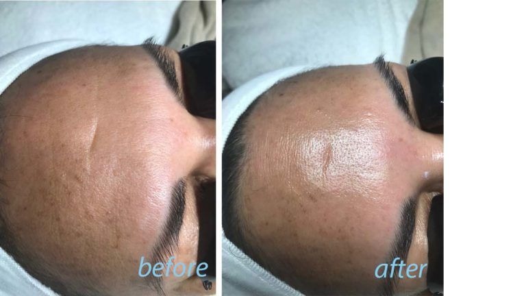 skin treatement result in glendora