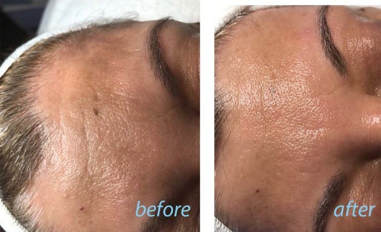 forhead skin before and after