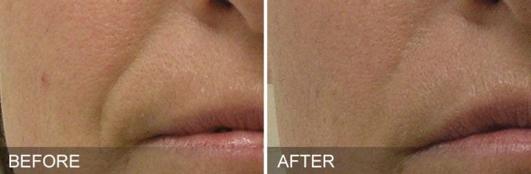 bofore and after cold plasma lips