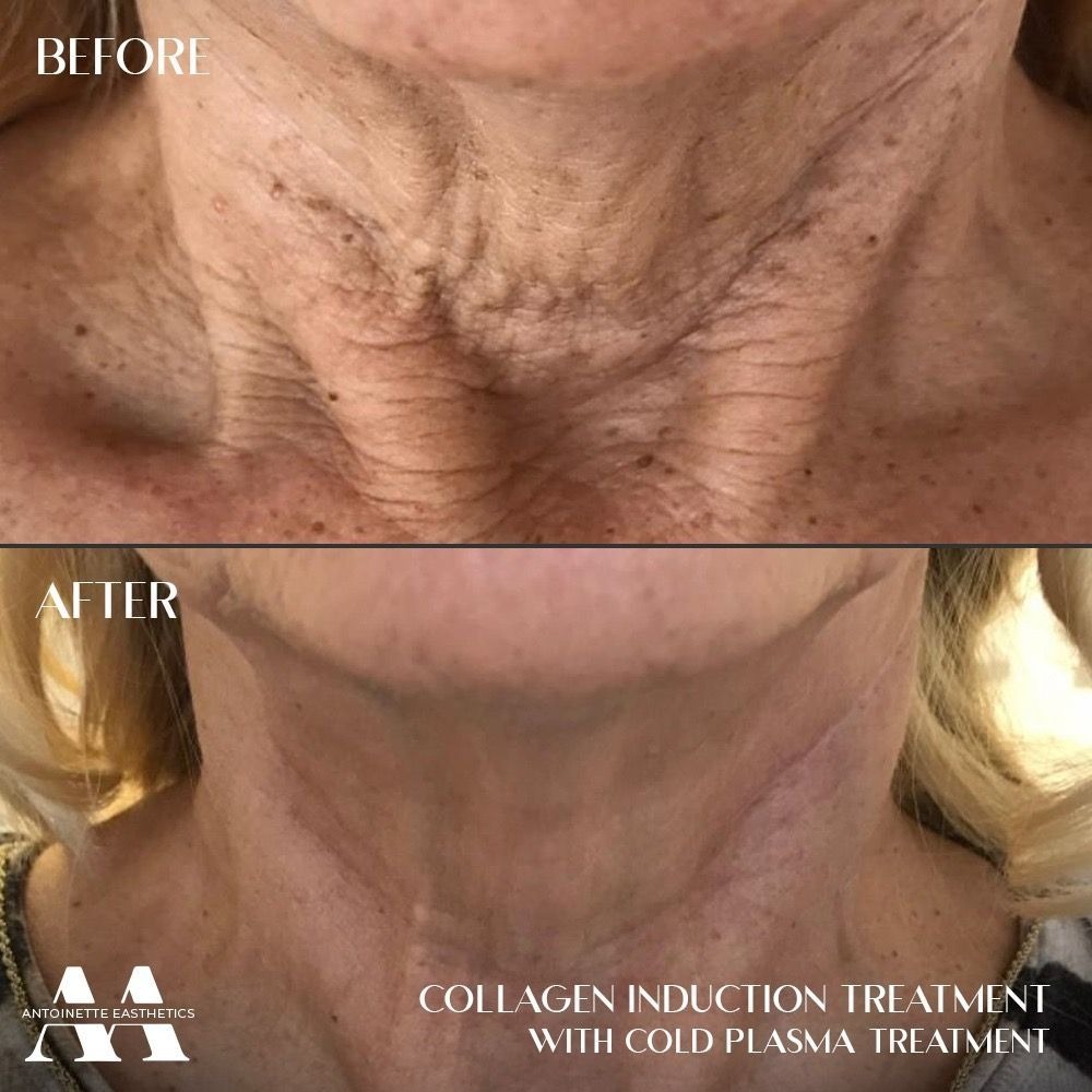 before and after PDRN