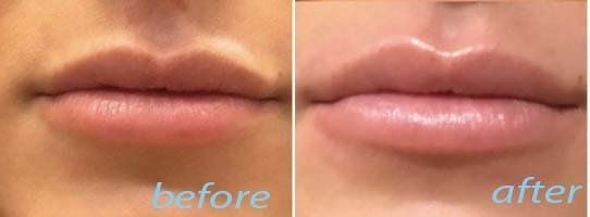 before and after lip treatment